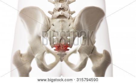 3d rendered medically accurate illustration of an arthritic coccyx