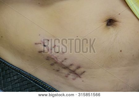 The Ugly Scar From Appendicitis Close Up