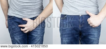Before And After Pain In The Bladder. Conceptual Shot. On The Left, The Man Grabbed His Bladder In P