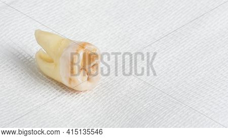 Pulled Out Wisdom Tooth With Filling And Caries On White Cheesecloth Background. Close Up Of Bad Wis