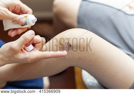 A Mother Is Applying Topical Antiseptic And Anti Inflammatory Cream Onto Bruised Skin Over The Knee 