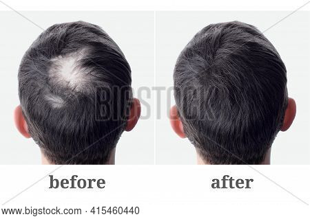 Male Head With Bald Head And Bald Head. Hair Transplantation And Extension. Before And After.