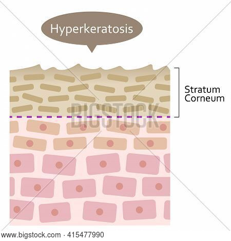 Diagram Of Skin Cell Turnover And Thickening Of The Stratum Corneum. Skin Care And Beauty Concept