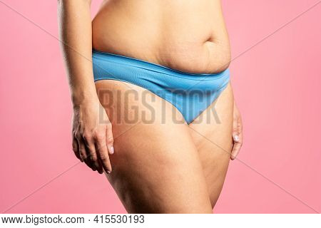 Tummy Tuck, Flabby Skin On A Fat Belly, Plastic Surgery Concept