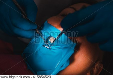 Treatment Of The Upper Sixth Left Tooth, Sterile Treatment With Roofing Felt.