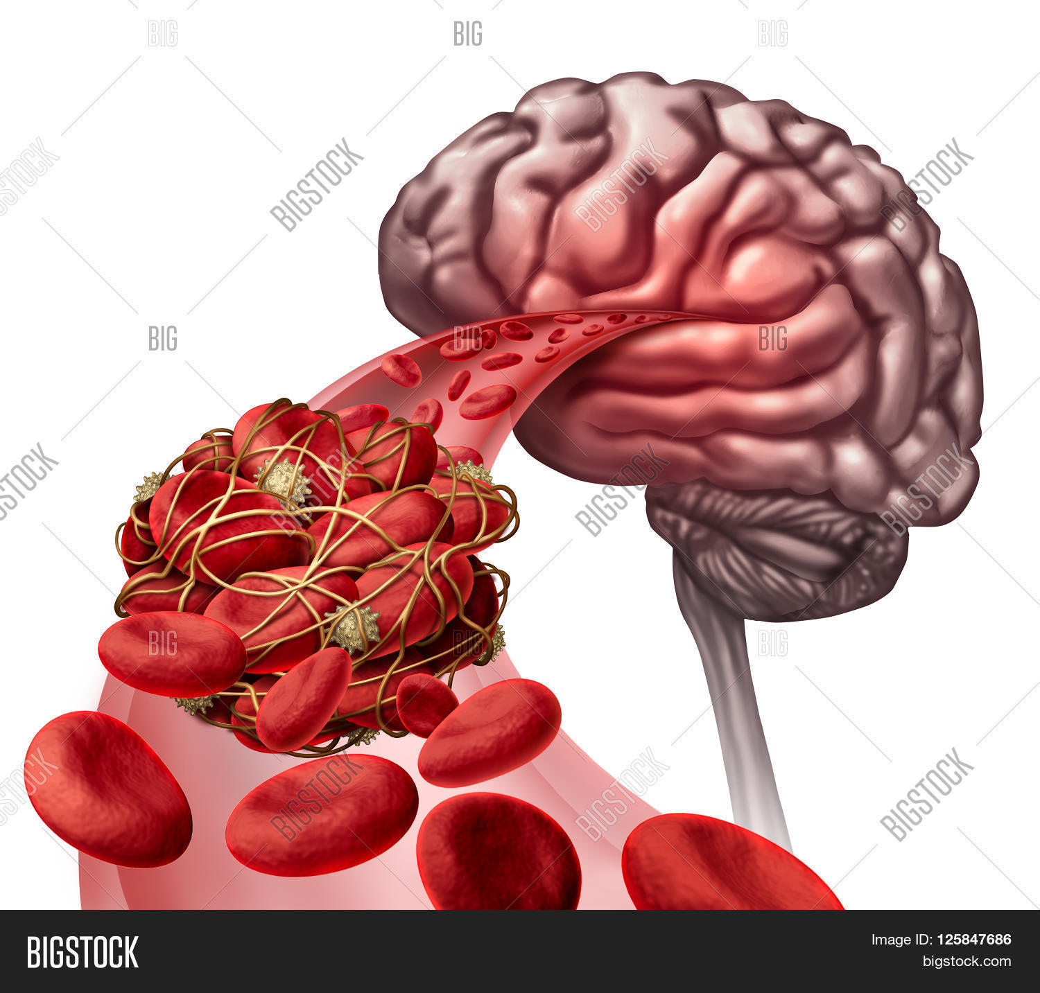 Brain Blood Clot Image & Photo (Free Trial) Bigstock