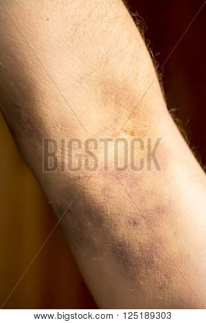 large hematoma on human arm after blood test black background