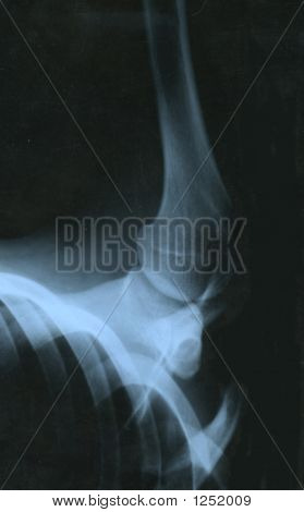 Radiografia della spalla