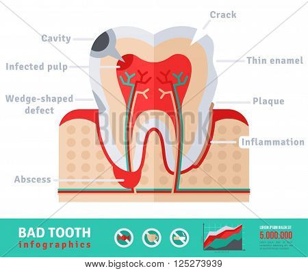 Bad tooth anatomy flat icon concept. Teeth infographics.Vector illustration. Infected pulp and nerves, thin enamel, plaque. Abscess.