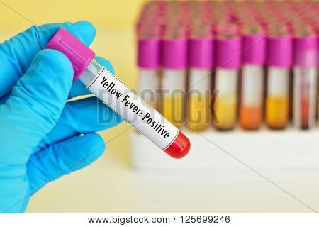 Blood sample positive with yellow fever test
