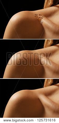 Tattoo on woman collarbone. Laser tattoo removal concept