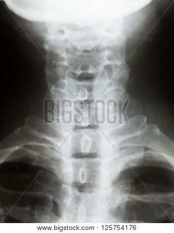X-Ray Image Of Human neck for a medical diagnosis