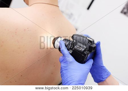 Method of dermatoscopy of skin lesions and moles. Preventing Melanoma and Skin Cancer