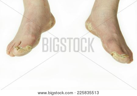 Extreme Bad Foot Skin Bacterial Fungal Infection With Damaged Nail Close Up Partially Isolated On Wh