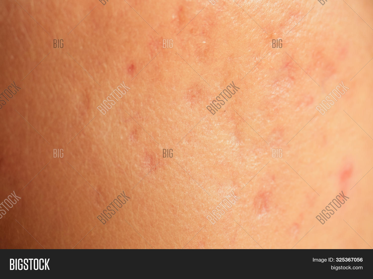Postacne, Scars Red Image & Photo (Free Trial) Bigstock