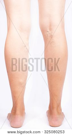 Varicose Expansion Veins On Female Legs ,disease Phlebeurysm.
