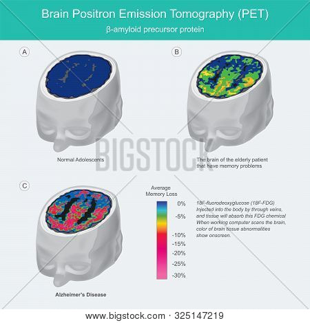 Brain Pet Scans. When Working Computer Scans The Brain, Colour Of Brain Tissue Abnormalities Show On