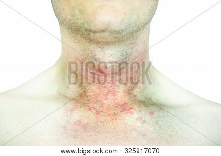 Atopic dermatitis (AD), also known as atopic eczema, is a type of skin inflammation (dermatitis).Ecz