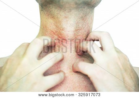 Atopic dermatitis (AD), also known as atopic eczema, is a type of skin inflammation (dermatitis)