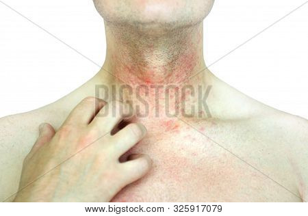 Atopic Dermatitis (ad), Also Known As Atopic Eczema, Is A Type Of Skin Inflammation (dermatitis).ecz