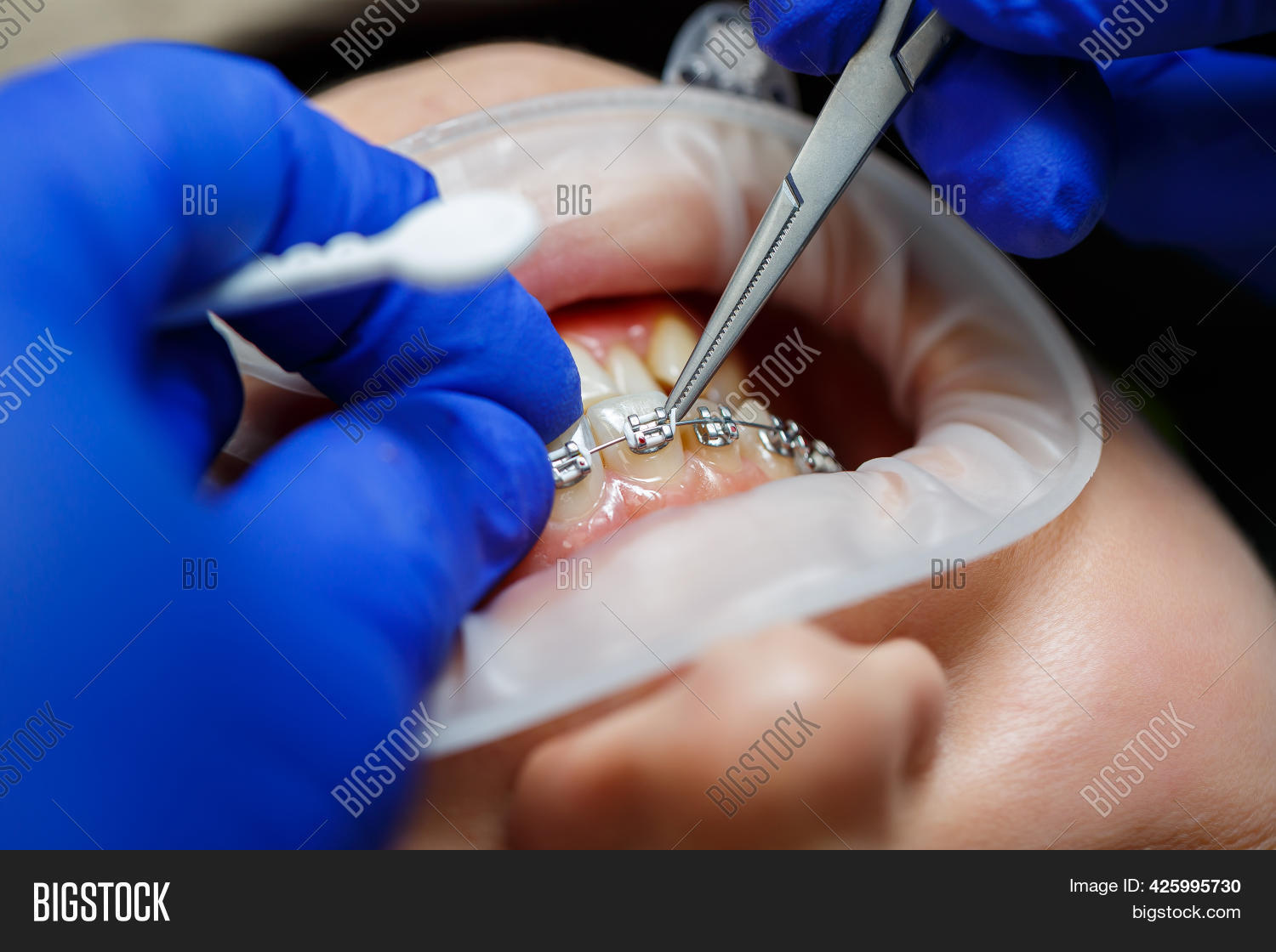 Installation Braces On Image & Photo (Free Trial) Bigstock