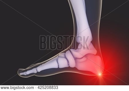 Foot And Ankle Pain, 3d Illustration. Foot Anatomy. Heel Spur