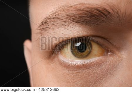 Man With Yellow Eyes On Black Background, Closeup. Liver Problems Symptom