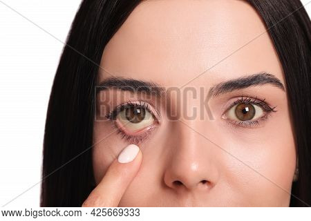 Woman Checking Her Health Condition On White Background, Closeup. Yellow Eyes As Symptom Of Problems
