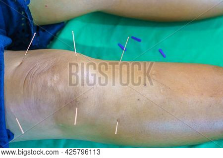 Close-up Of Khee And Leg With Steel Needle During Procedure Of Acupuncture Therapy. Alternative Medi