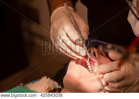 Bonding Of Dental Braces And Expander. Orthodontic Treatment. Dentist Put On Metal Brackets Using Ad