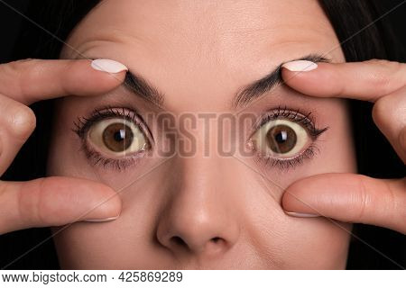 Woman Checking Her Health Condition, Closeup. Yellow Eyes As Symptom Of Problems With Liver