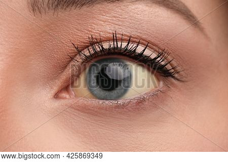 Woman With Yellow Eyes As Background, Closeup. Liver Problems Symptom