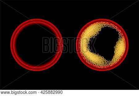 Arteriosclerosis, Infarct, Ischemia, Thrombosis Disease. Cholesterol In Human Blood Vessels. High Ld