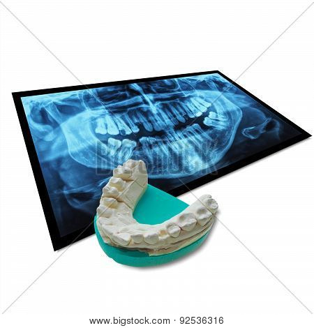Xray Of Teeth With Positive Teeth Cast