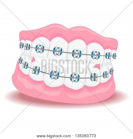 Vector Illustration of Dentures Teeth with Braces