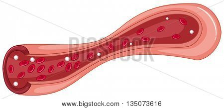 Close up diagram of blood clot