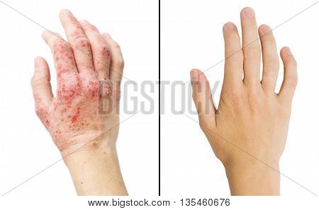 Real Photo Girl's Hand, The Patient With Eczema Before And After Treatment