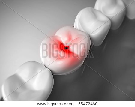 3d rendered, medically accurate 3d illustration of a painful tooth