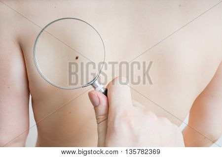 Doctor holds magnifying glass in hand and is examining patient skin for melanoma suspicion.