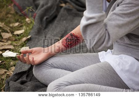 Training Simulation Of Serious Injury On A Girls Arm. Moulage.