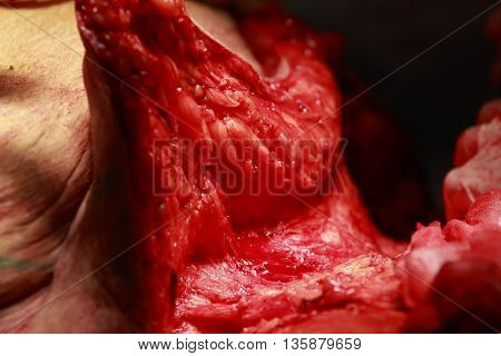 Close-Up of an excess subcutaneous fat removal