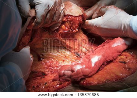 Human's flesh close-up with a fat and other tissues while surgeons lifts up the skin