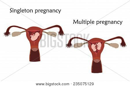 Multiple And Singleton Pregnancy, Twins, Embryo, Fetus In Uterus, Placenta, Umbilical Cord. Vector F