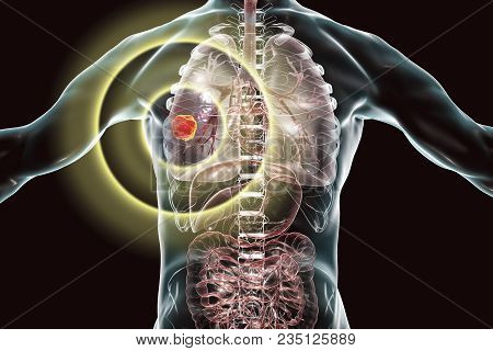 Lung Cancer Treatment And Prevention Concept, 3d Illustration
