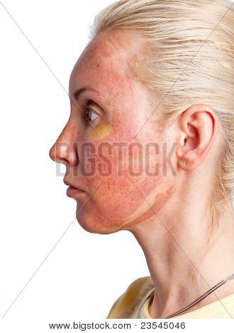 Kozmetik. Koşul TCA peeling kimyasal sonra cilt. Yırtılma başında en iyi bur uzakta
