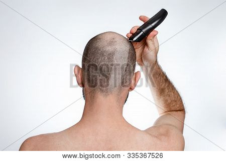 The Concept Of Baldness And Alopecia. A Man Holds A Hair Clipper And Shaves The Hair On Top Of His H