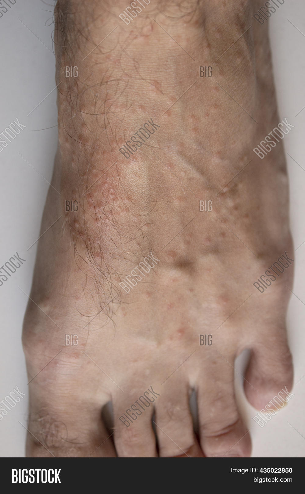 Allergic Reaction On Image & Photo (Free Trial) Bigstock
