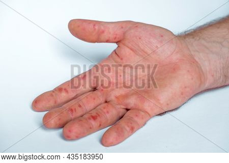 Painful Rash, Red Spots Blisters On The Hand. Close Up Allergy Rash, Human Hands With Dermatitis And