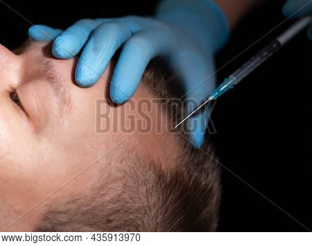 The Doctor Makes An Injection Of Homeopathic Mesotherapy Hair Of The Skin On The Man's Head. Baldnes