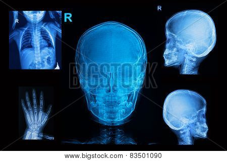 Collection Of Children X-rays  Image Show Skull  Chest And Hand Image